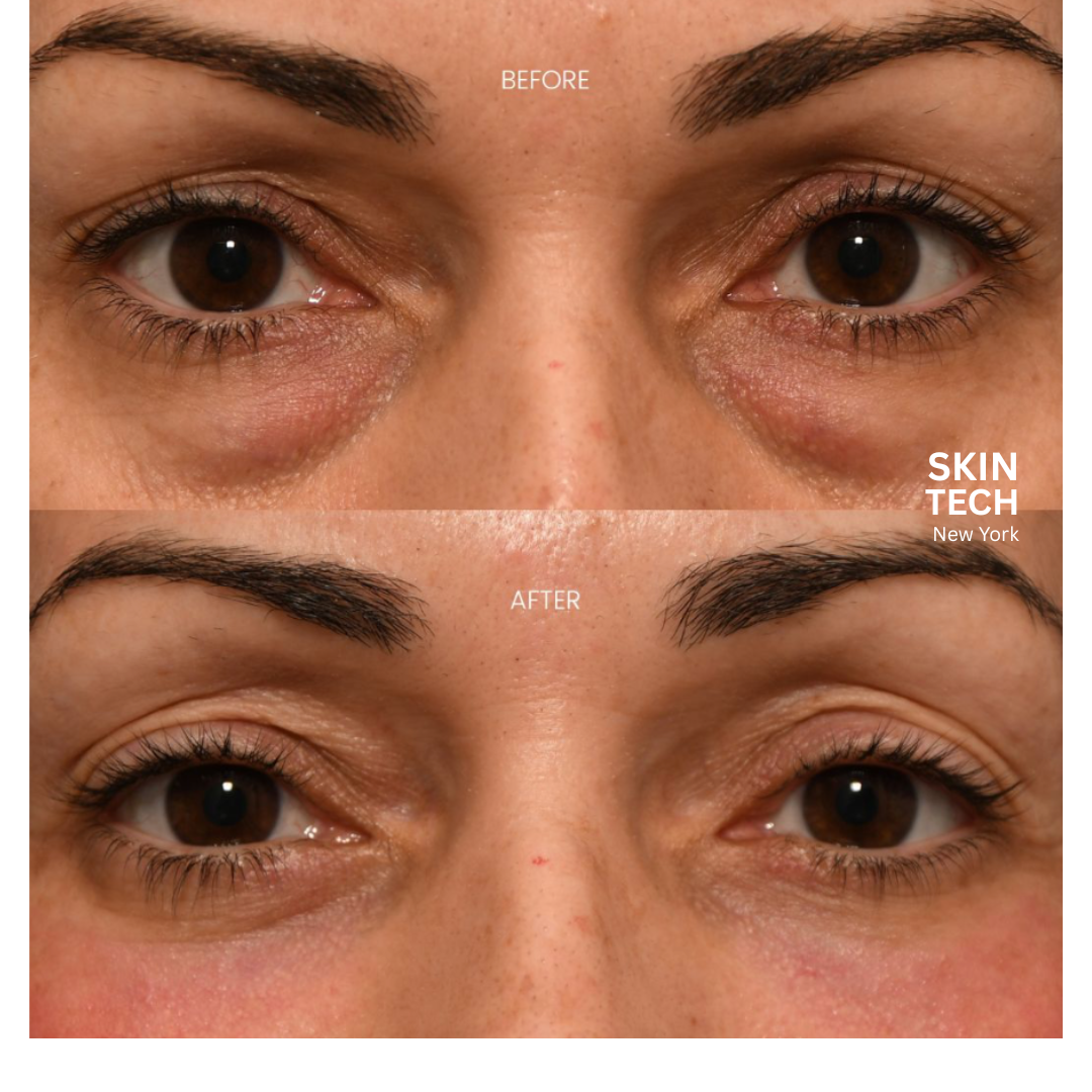 Lifting Eye Mask Technology by SkinTech New York